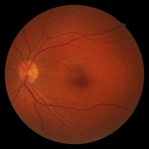 fundusfoto optometrist